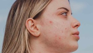 Donna acne